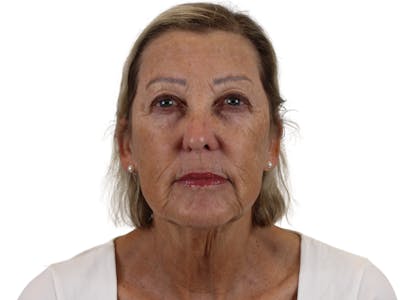Deep Neck Lift Before & After Gallery - Patient 141525496 - Image 1