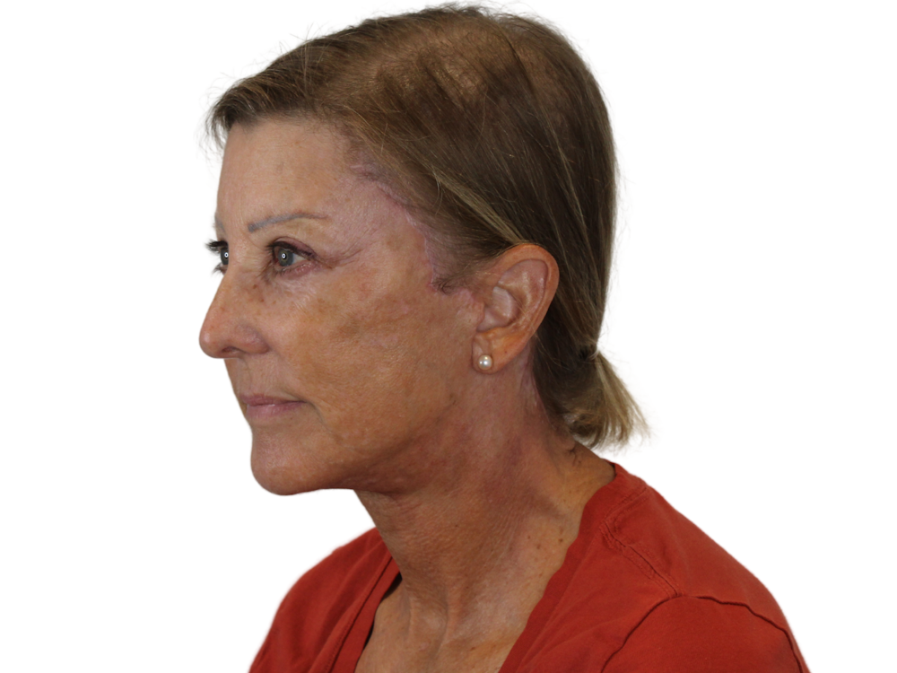 Deep Neck Lift Before & After Gallery - Patient 141525496 - Image 6