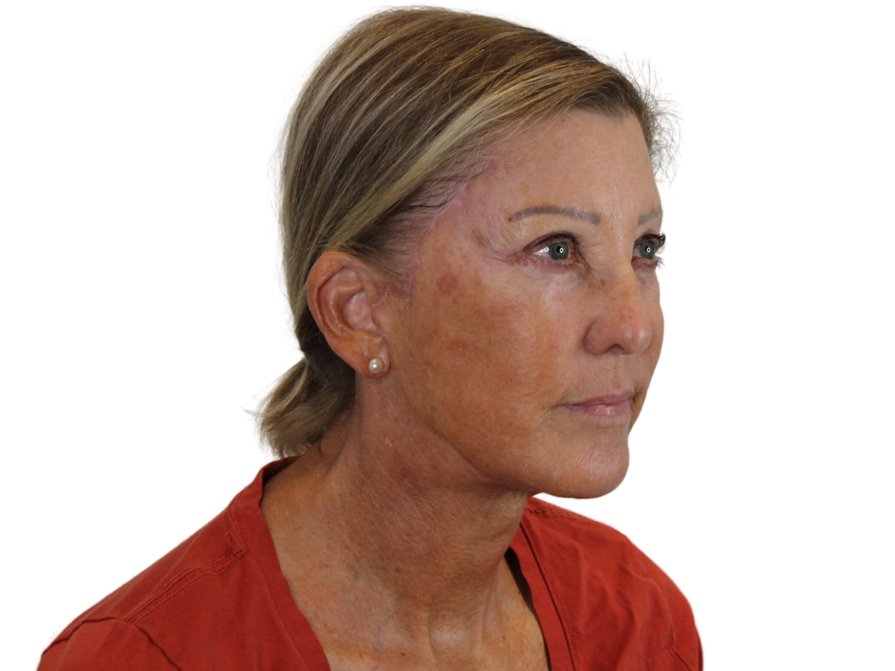 Deep Plane Facelift Before & After Gallery - Patient 141525494 - Image 4