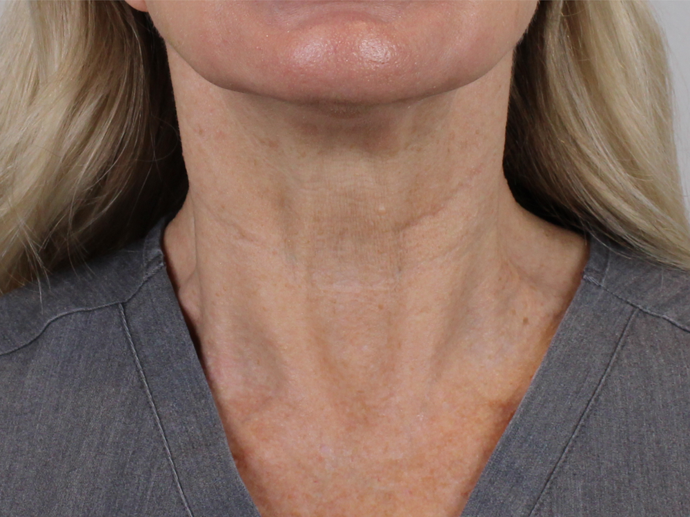 BOTOX  Before & After Gallery - Patient 142006937 - Image 2