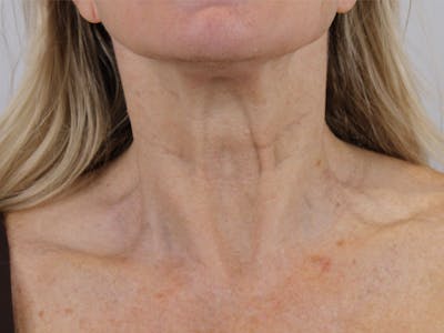 BOTOX  Before & After Gallery - Patient 142006937 - Image 1
