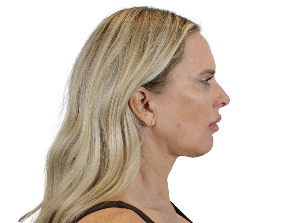 Jawline Filler  Before & After Gallery - Patient 142006945 - Image 1