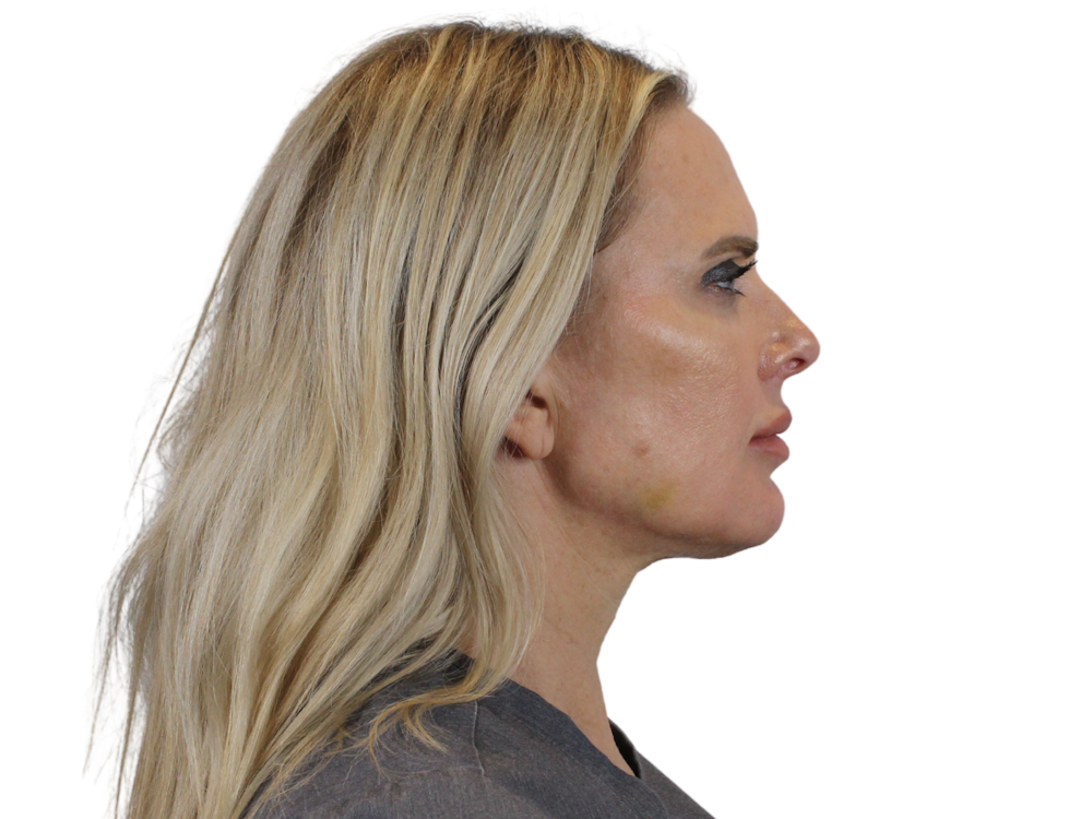Chin Filler Before & After Gallery - Patient 142006943 - Image 2