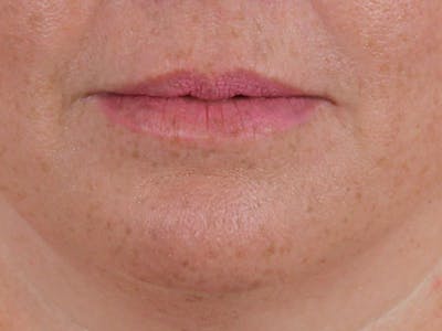 Lip Filler Before & After Gallery - Patient 142006953 - Image 1