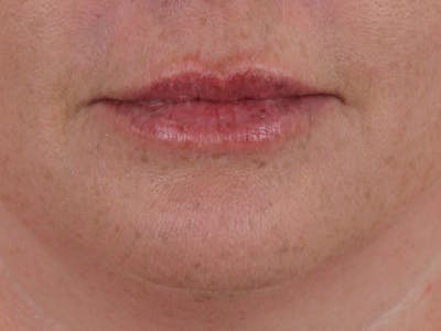 Lip Filler Before & After Gallery - Patient 142006953 - Image 2