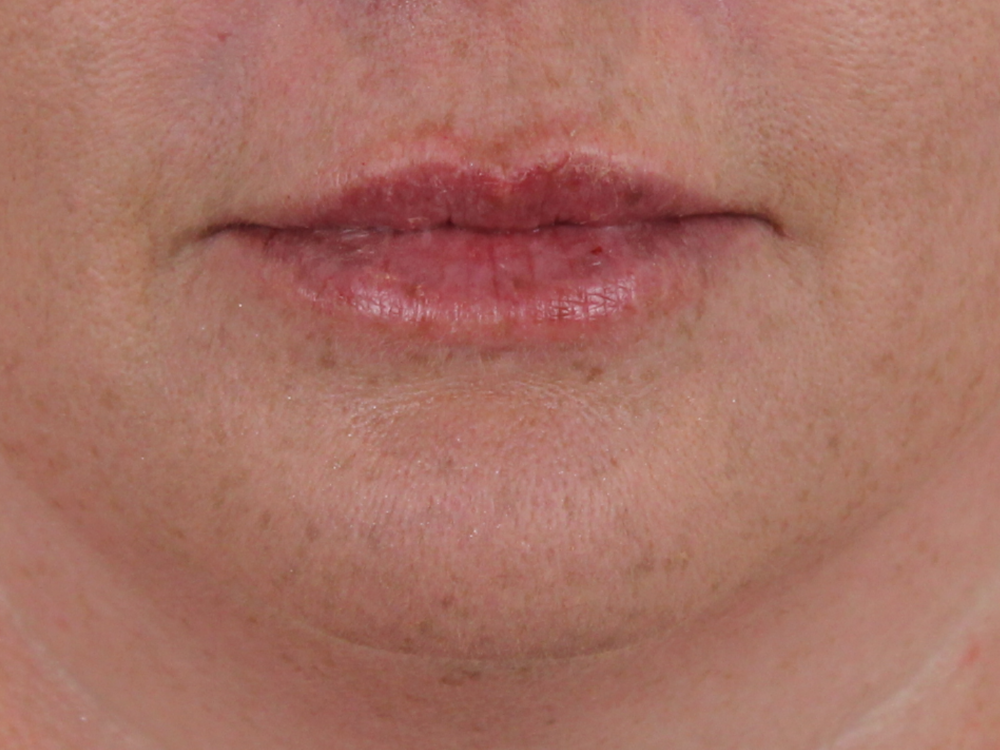 Lip Filler Before & After Gallery - Patient 142006953 - Image 2