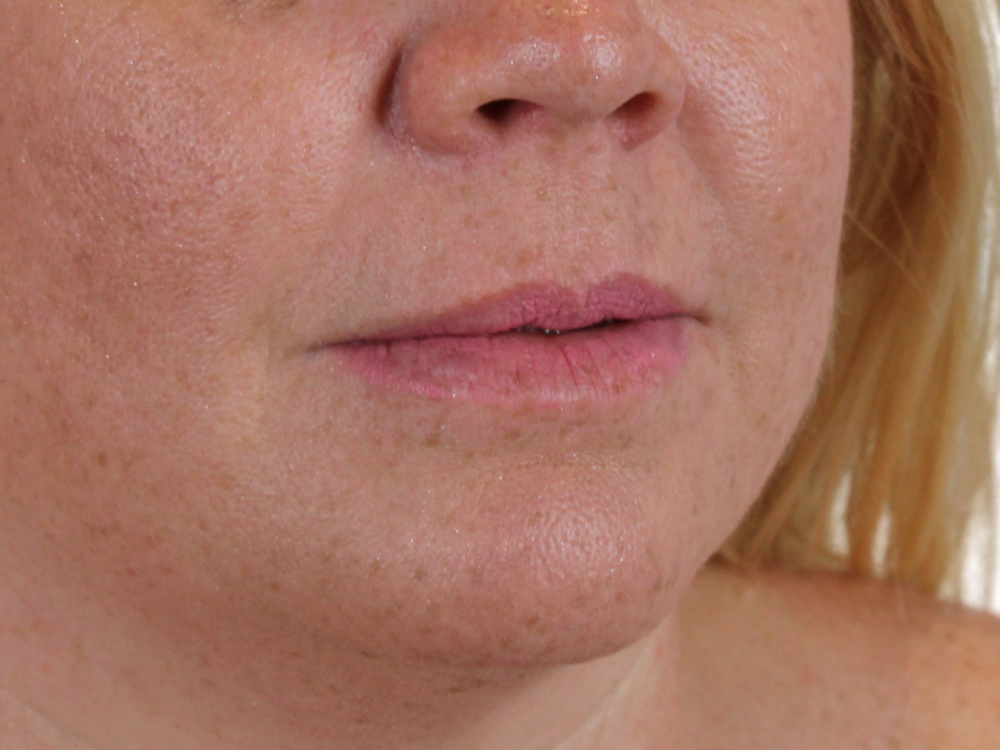 Lip Filler Before & After Gallery - Patient 142006953 - Image 3