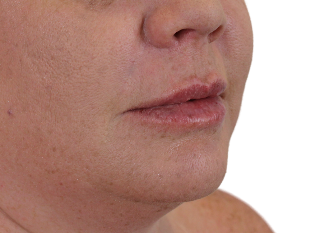 Lip Filler Before & After Gallery - Patient 142006953 - Image 4