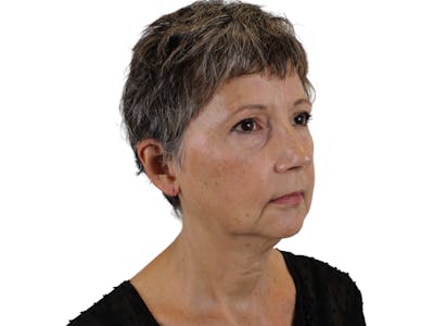 Deep Neck Lift Before & After Gallery - Patient 142006982 - Image 1