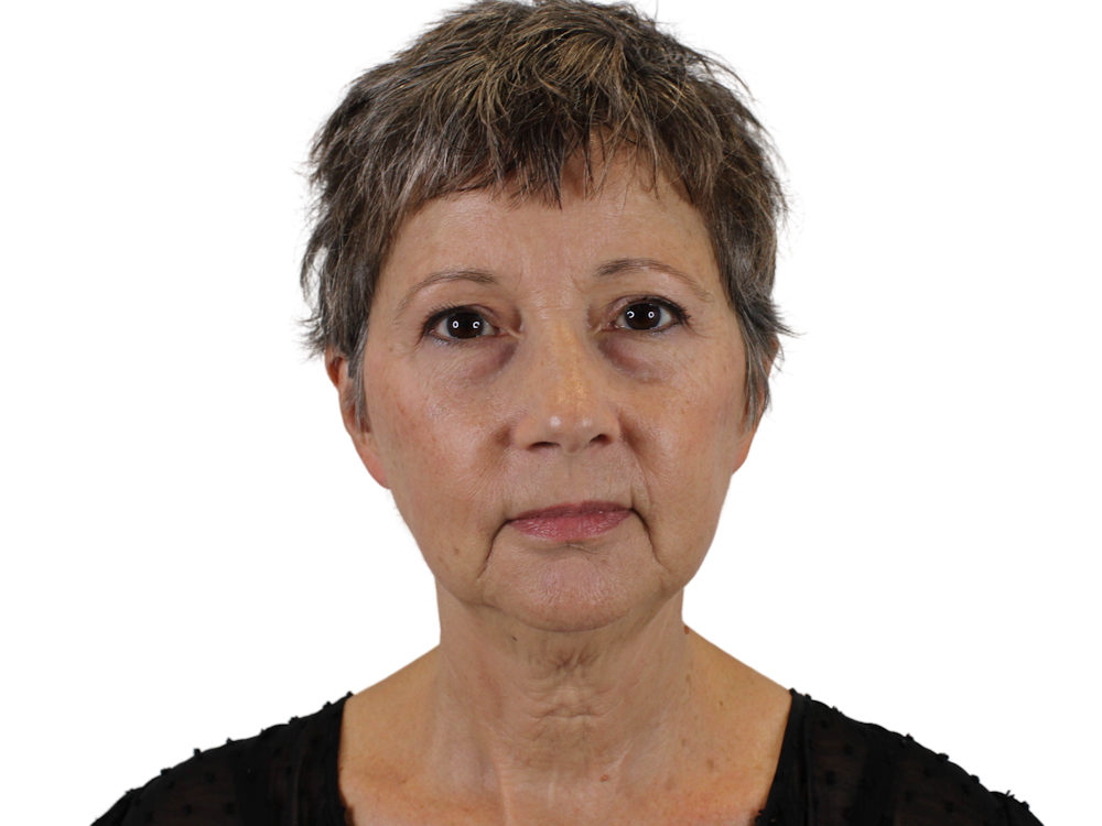 Facelift Before & After Gallery - Patient 142006980 - Image 3