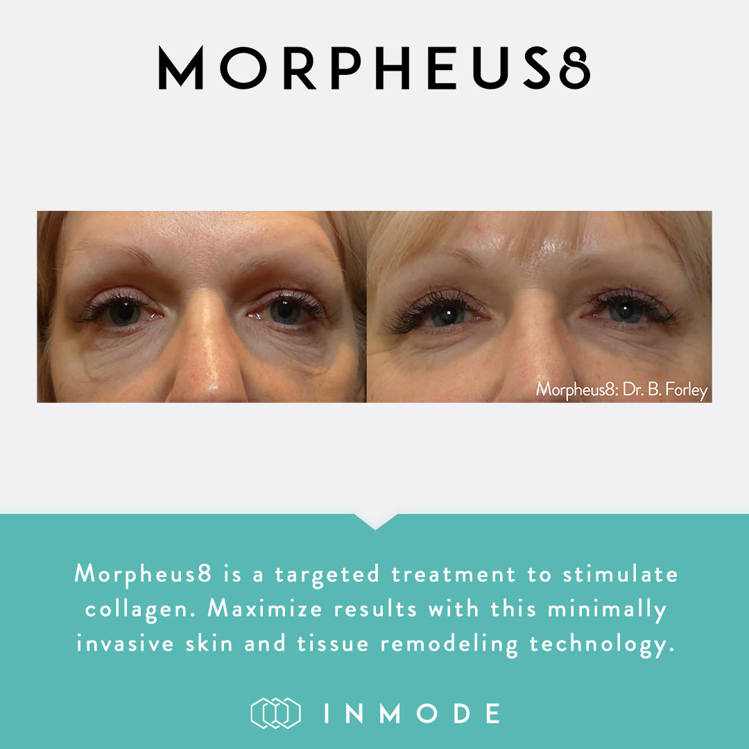 morpheus8 before and after