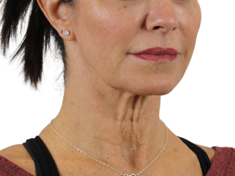 Deep Neck Lift Before & After Gallery - Patient 143555004 - Image 1