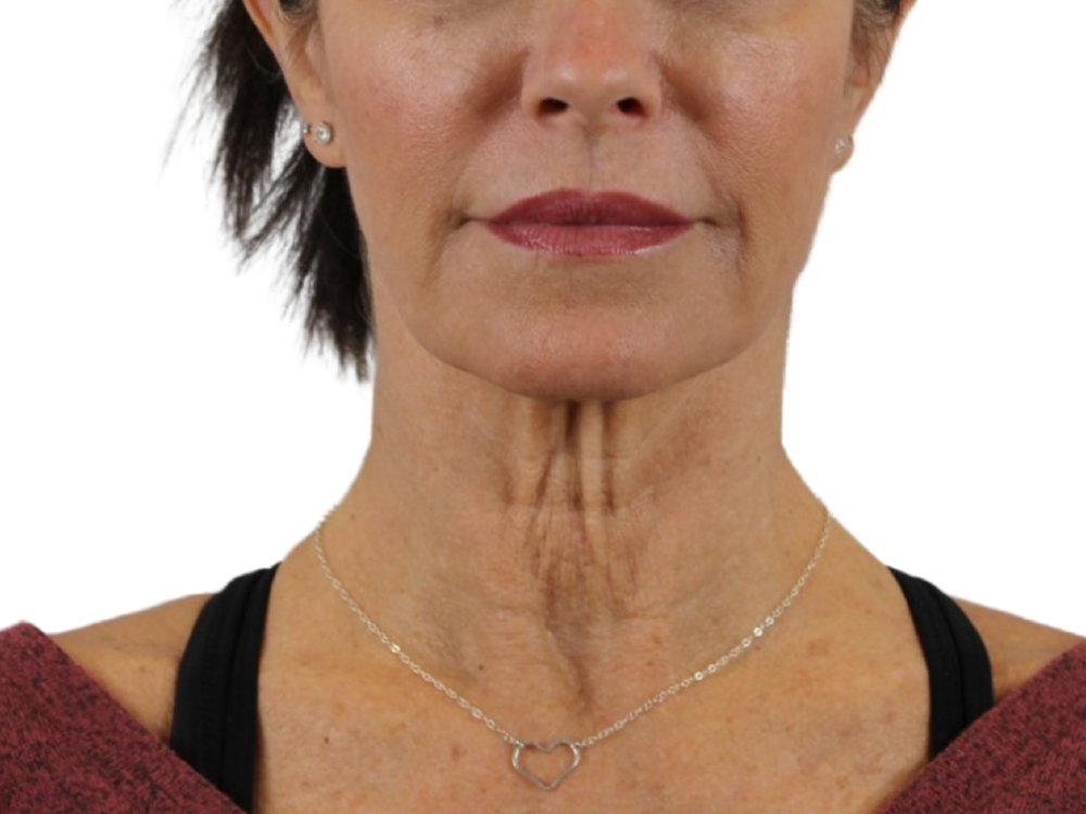 Deep Neck Lift Before & After Gallery - Patient 143555004 - Image 3
