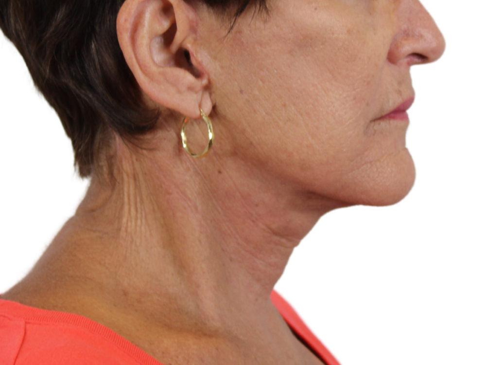 Deep Neck Lift Before & After Gallery - Patient 143555017 - Image 2