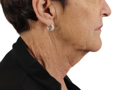 Deep Neck Lift Before & After Gallery - Patient 143555017 - Image 1