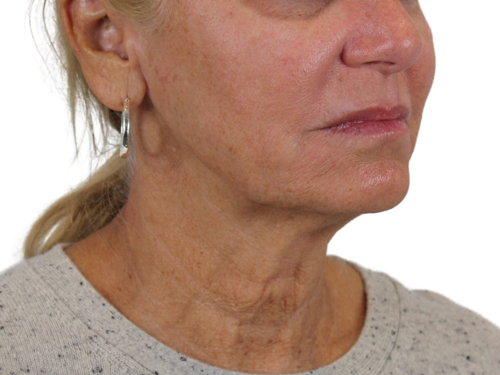 Deep Neck Lift Before & After Gallery - Patient 143555058 - Image 1