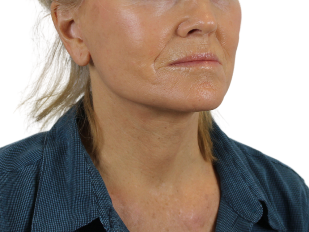 Neck Lift Before & After Gallery - Patient 143555057 - Image 2