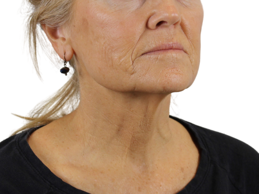 Deep Neck Lift Before & After Gallery - Patient 143555057 - Image 1