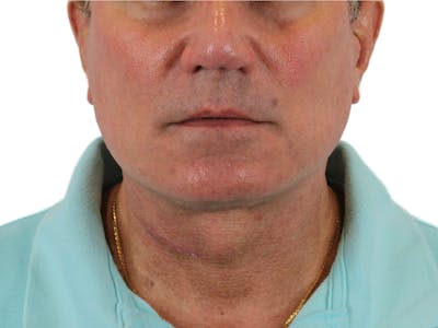 Neck Lift Before & After Gallery - Patient 143555056 - Image 2