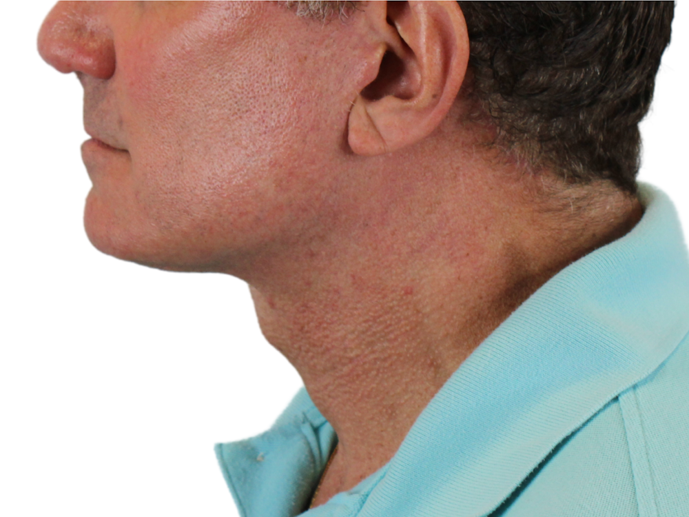 Neck Lift Before & After Gallery - Patient 143555056 - Image 8