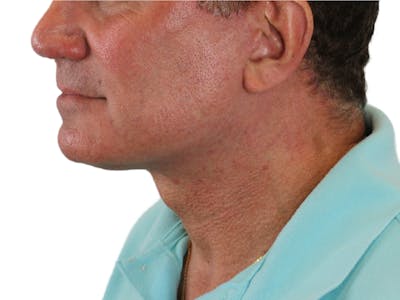 Neck Lift Before & After Gallery - Patient 143555056 - Image 6