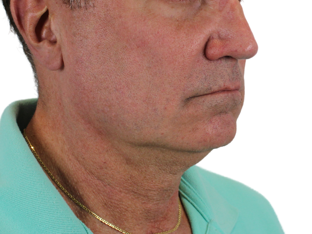 Neck Lift Before & After Gallery - Patient 143555056 - Image 3