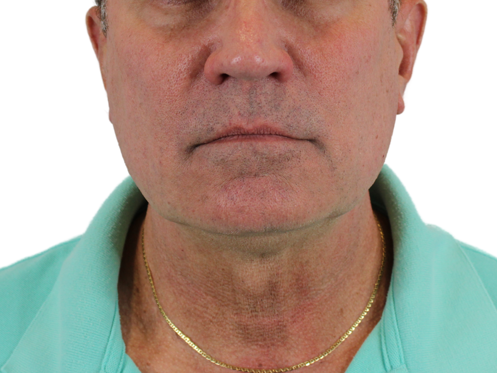 Neck Lift Before & After Gallery - Patient 143555056 - Image 1