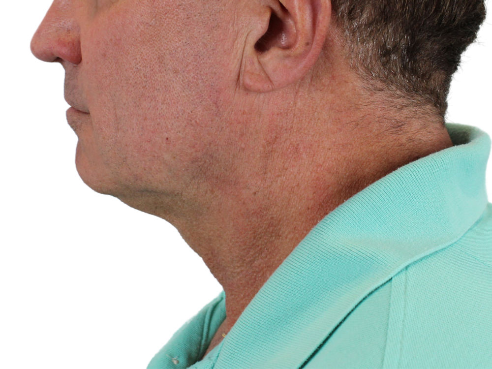 Neck Lift Before & After Gallery - Patient 143555056 - Image 7