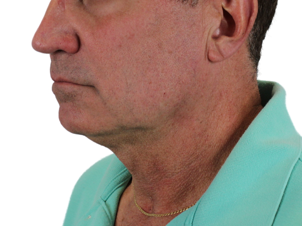 Neck Lift Before & After Gallery - Patient 143555056 - Image 5