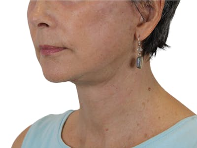 Neck Lift Before & After Gallery - Patient 143555064 - Image 4