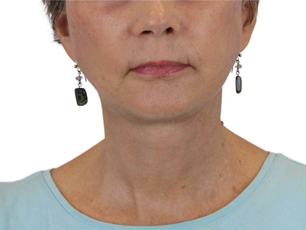 Deep Neck Lift Before & After Gallery - Patient 143555064 - Image 2