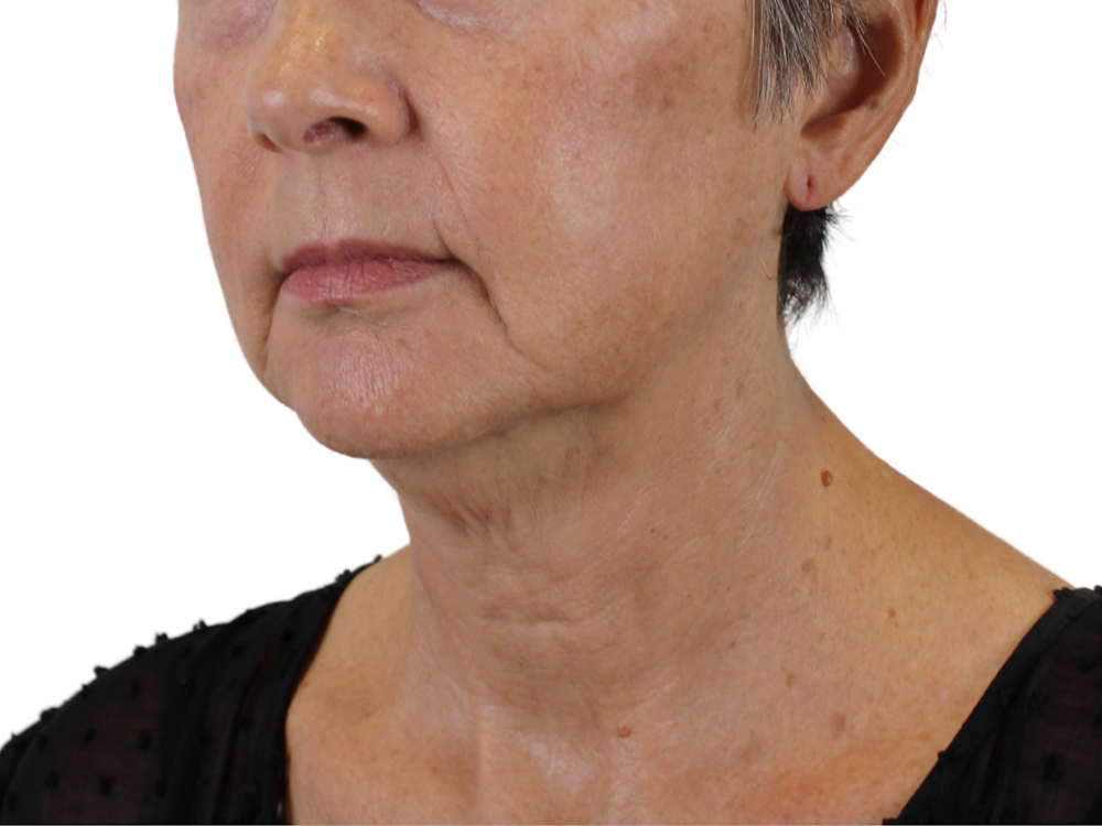 Deep Neck Lift Before & After Gallery - Patient 143555064 - Image 3