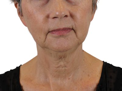 Neck Lift Before & After Gallery - Patient 143555064 - Image 1