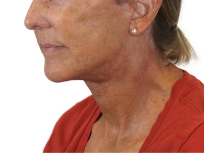 Deep Neck Lift Before & After Gallery - Patient 143555065 - Image 8