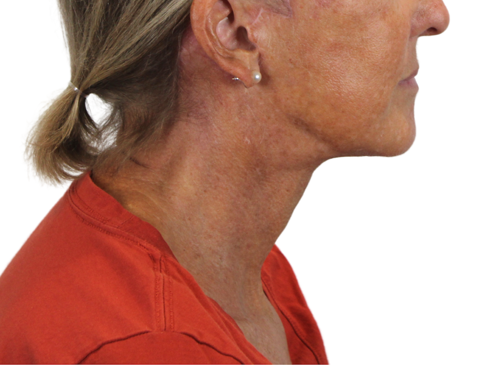 Deep Neck Lift Before & After Gallery - Patient 143555065 - Image 6