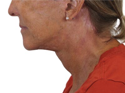 Deep Neck Lift Before & After Gallery - Patient 143555065 - Image 10