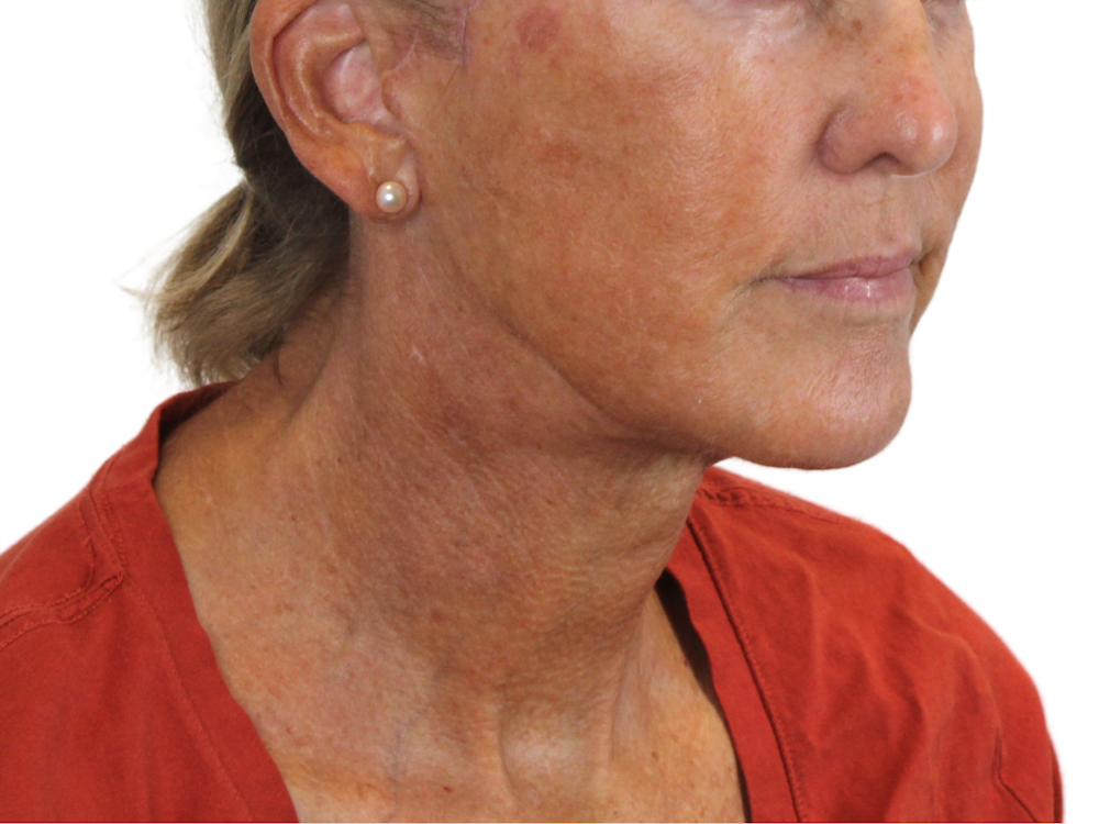 Deep Neck Lift Before & After Gallery - Patient 143555065 - Image 4