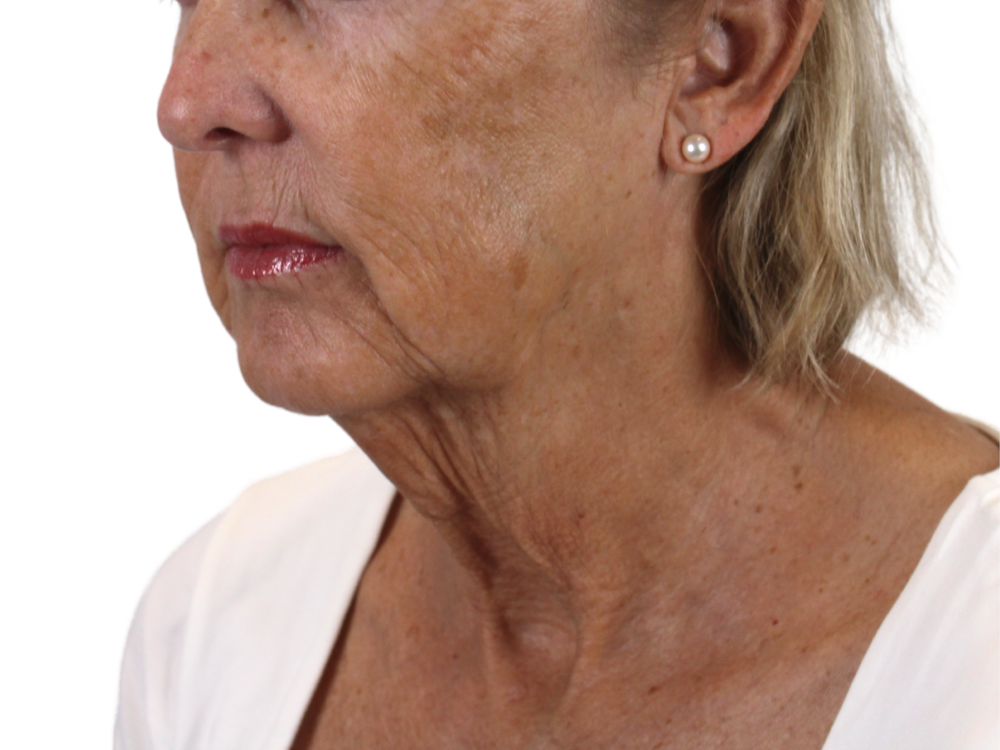 Deep Neck Lift Before & After Gallery - Patient 143555065 - Image 7