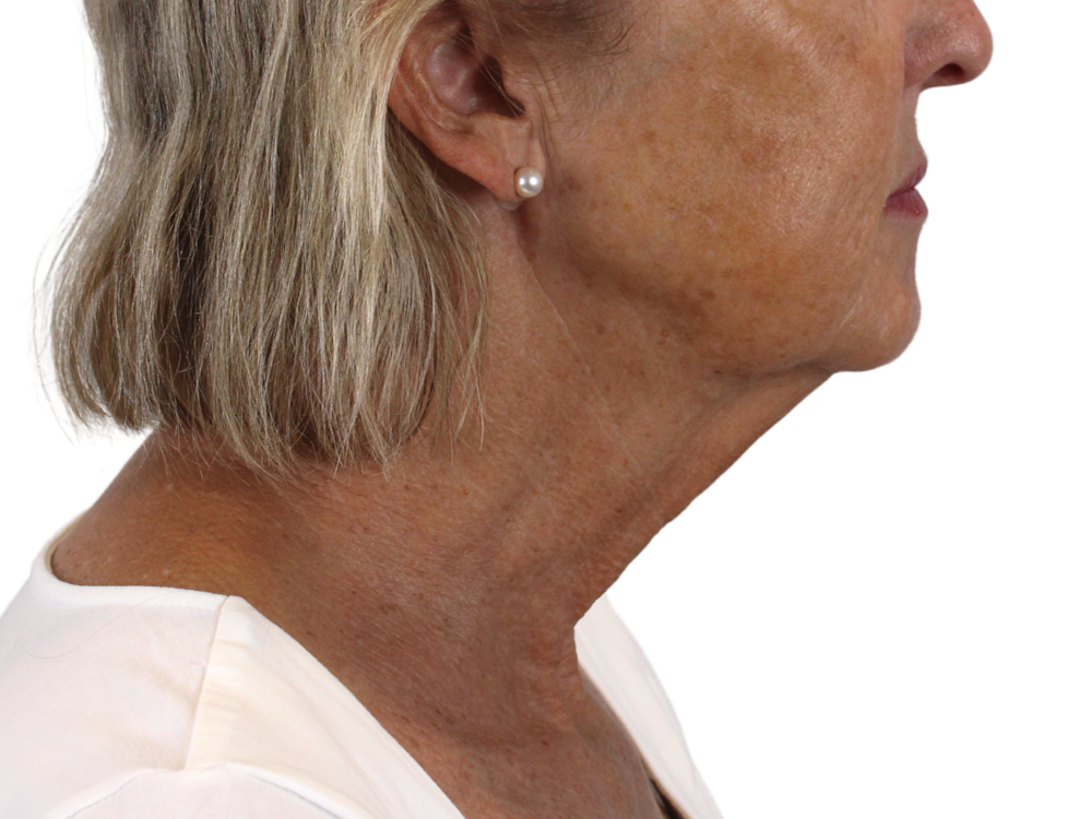 Neck Lift Before & After Gallery - Patient 143555065 - Image 3