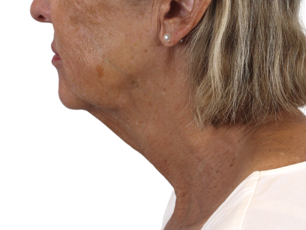 Deep Neck Lift Before & After Gallery - Patient 143555065 - Image 9