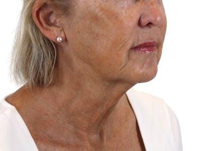 Deep Neck Lift Before & After Gallery - Patient 143555065 - Image 1