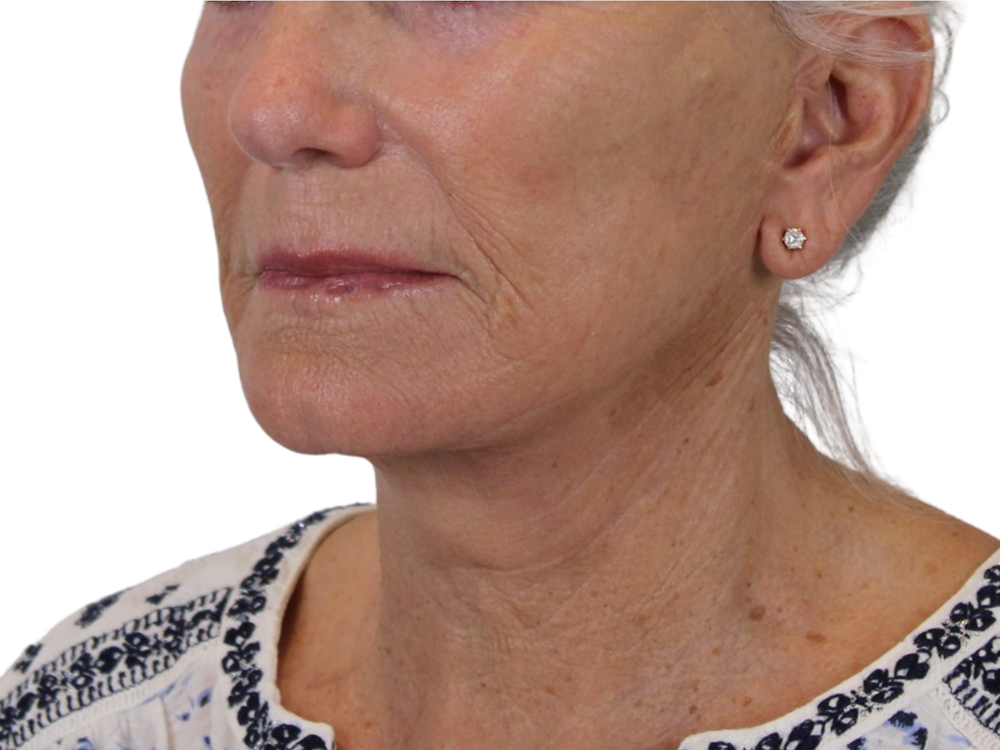 Neck Lift Before & After Gallery - Patient 143555688 - Image 4