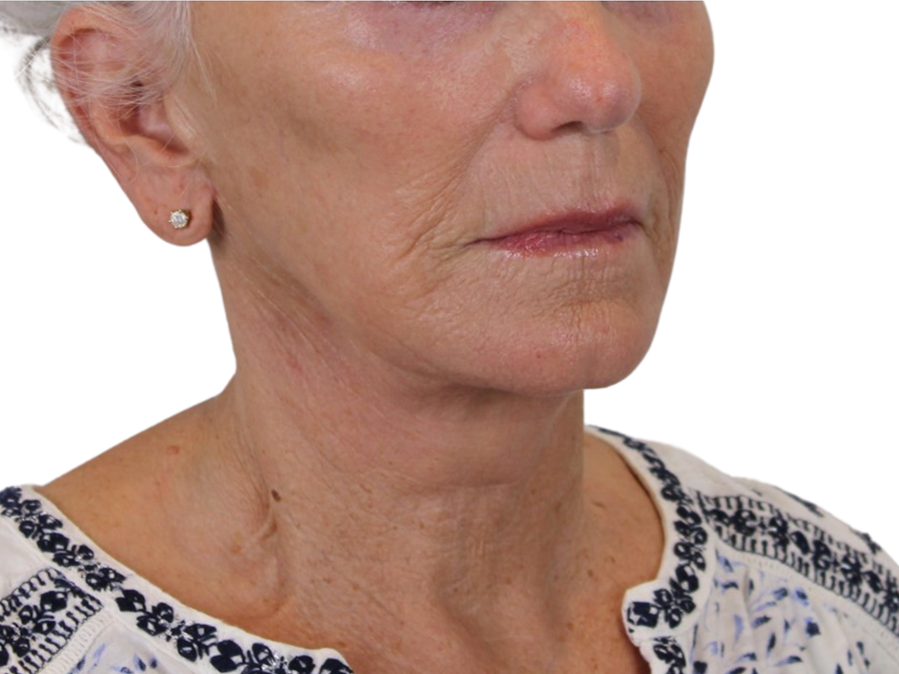 Deep Neck Lift Before & After Gallery - Patient 143555688 - Image 2