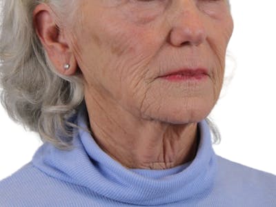 Deep Neck Lift Before & After Gallery - Patient 143555688 - Image 1