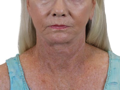 Deep Neck Lift Before & After Gallery - Patient 143555692 - Image 2