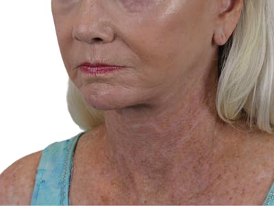 Deep Neck Lift Before & After Gallery - Patient 143555692 - Image 4