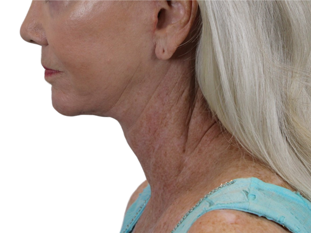 Deep Neck Lift Before & After Gallery - Patient 143555692 - Image 6
