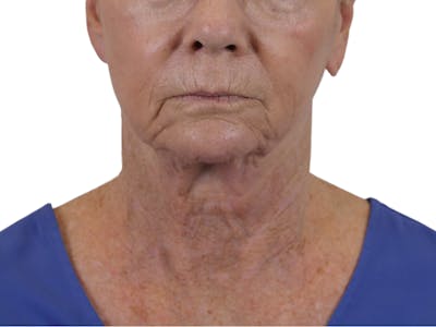 Deep Neck Lift Before & After Gallery - Patient 143555692 - Image 1