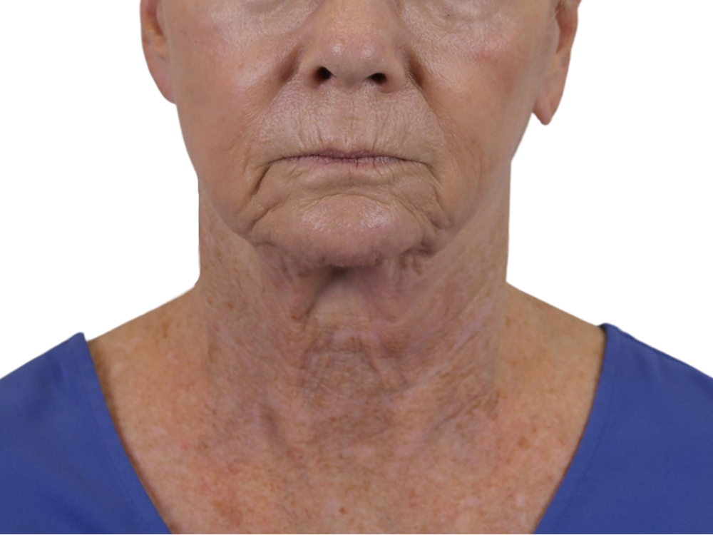 Deep Neck Lift Before & After Gallery - Patient 143555692 - Image 1