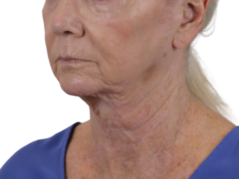 Neck Lift Before & After Gallery - Patient 143555692 - Image 3